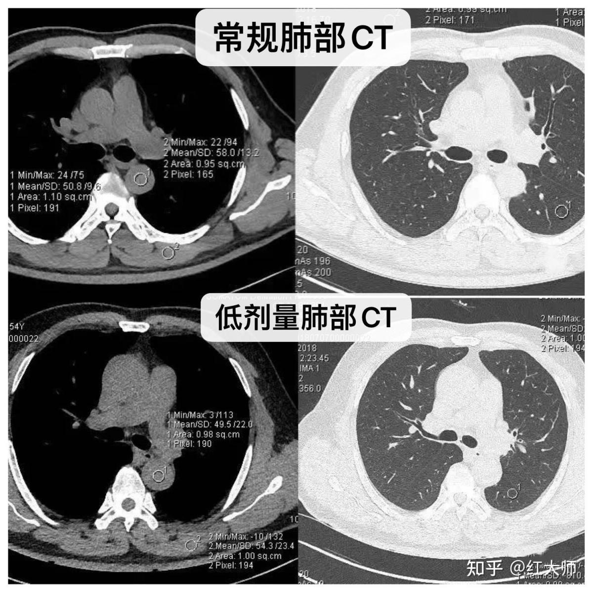 关于低剂量肺部CT的真相 - 知乎